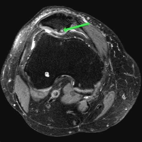 Patellofemoral Chondromalacia - ProScan Education