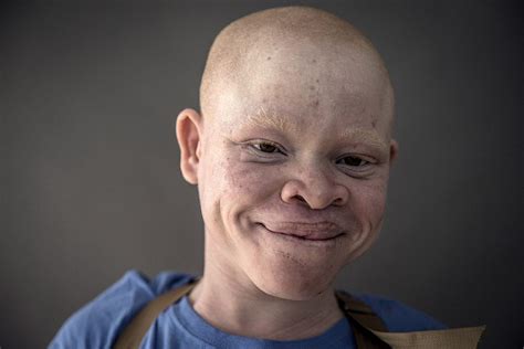 See Horrific Reasons Albinos Are Being Hunted & Killed In Malawi