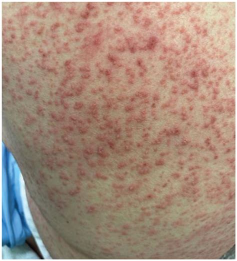 Widespread Pink To Erythematous Papules Vesicles And Bullae With A