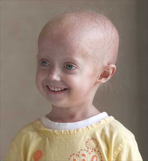 Gene Discovery Speeds Progeria Research Genetics And Genomics Jama