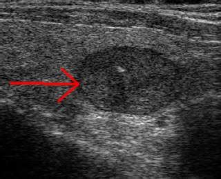 Following Thyroid Nodules with Ultrasound - Jeffrey Dach MD