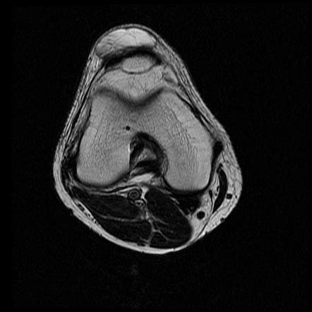 Prepatellar Bursitis Image Radiopaedia Org