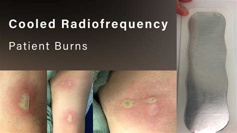 Cooled Radiofrequency Patient Burns Youtube