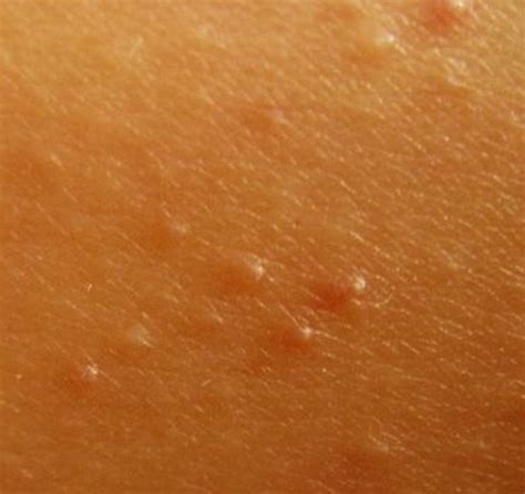 Keratosis Pilaris - Pictures, Treatment, Symptoms and Causes | HubPages