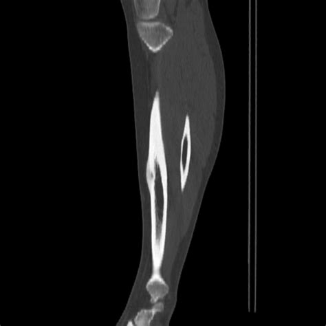 Osteoid Osteoma Image