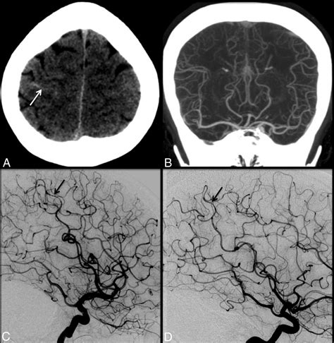 Reversible Cerebral Vasoconstriction Syndrome Part 1 Epidemiology Pathogenesis And Clinical