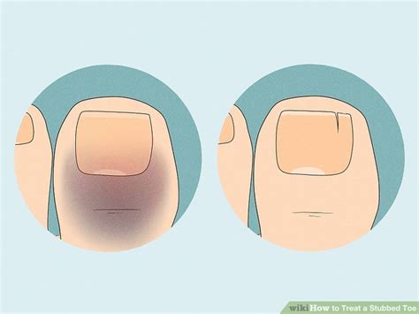 How To Treat A Stubbed Toe Steps With Pictures Wikihow