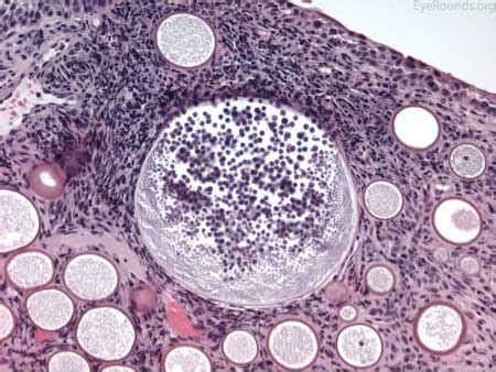 Conjunctival Rhinosporidiosis In A Temperate Climate