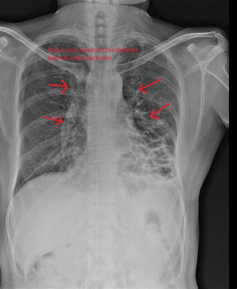 Bronchiectasis X Ray Tram Track