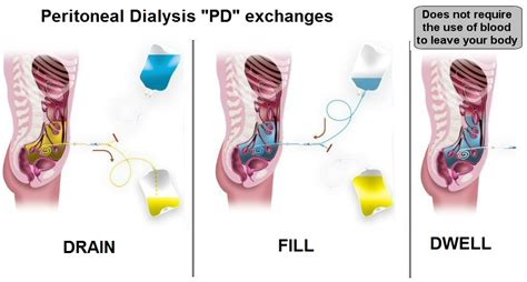 Continuous Ambulatory Peritoneal Dialysis Dwell Time