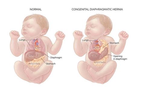 Congenital Diaphragmatic Hernia In Babies What Is It Types And