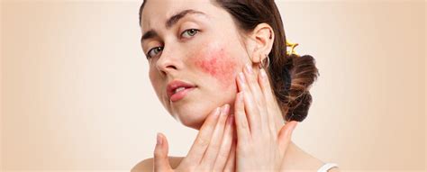 Acne And Rosacea Similarities And Differences