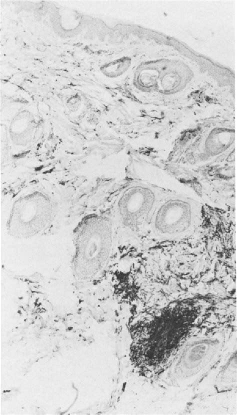 Figure 1 From Nevus Of Ota Associated With Meningeal Melanosis And