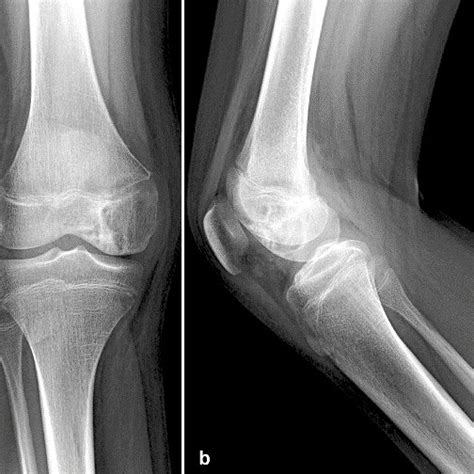 A Preoperative Antero Posterior And B Lateral View Radiographs Lytic Download Scientific