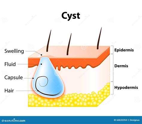 Sebaceous Cyst Diagram