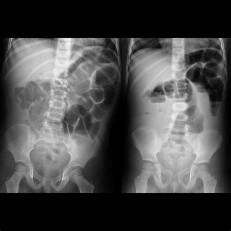 Small Bowel Obstruction Air Fluid Levels