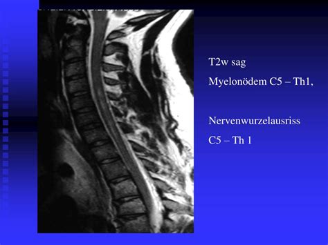 PPT MRT bei Plexus brachialis Läsionen PowerPoint Presentation free