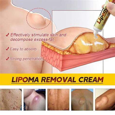 1pcs Lipoma Removal Cream Reduce Inflammation Treat Subcutaneous Lumps