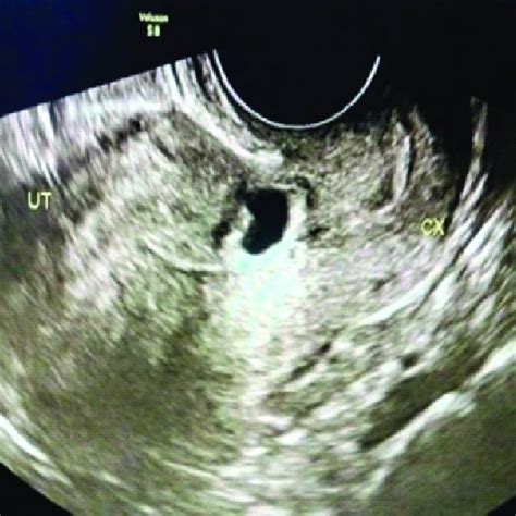 C Transvaginal Sonography Tvs Sagiial View Of The Uterus Showing The