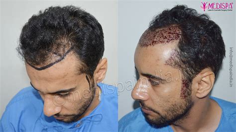 International Hair Transplant After Before Results