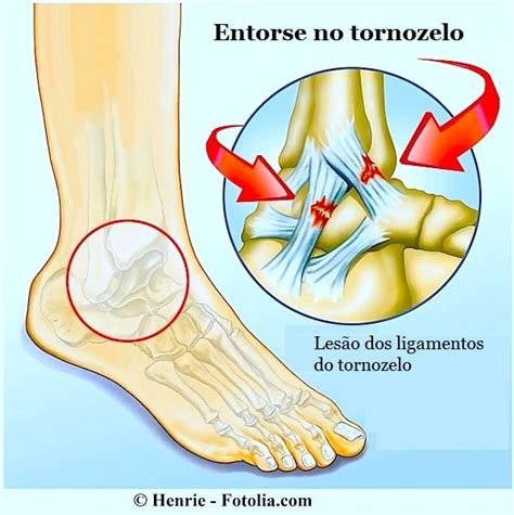 Tornozelos e pés inchados causas dieta e medicamentos