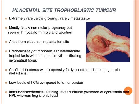 Gestational Trophoblastic Disease Part 2 1 Copy