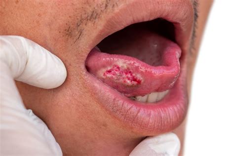 Early Signs Of Gum Cancer From Chewing Tobacco