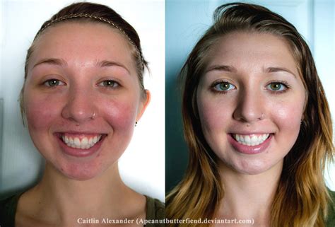 Before And After Braces: Before And After Braces Reddit