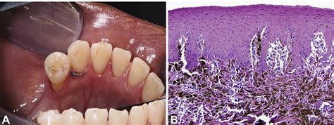 Premalignant And Malignant Oral Mucosal Lesions Clinical And