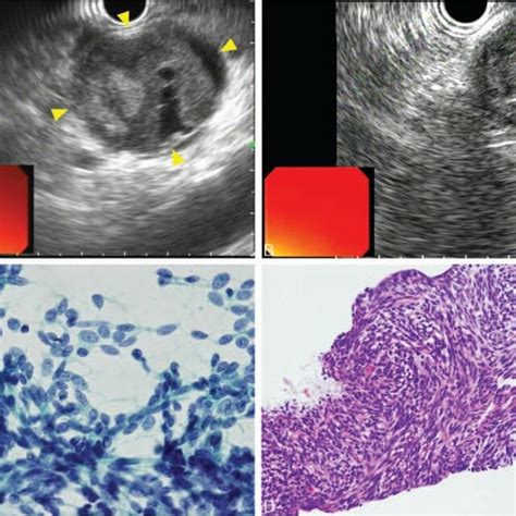 Endoscopic Ultrasound Eus Guided Fine Needle Aspiration Fna Of The