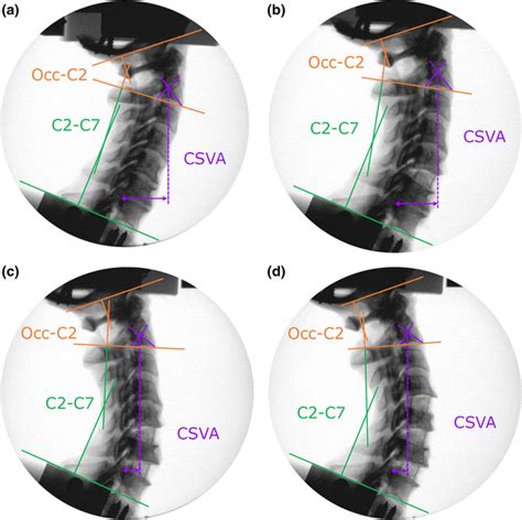 Representative Lateral Radiographs And Measurements A Intact Specimen Download Scientific