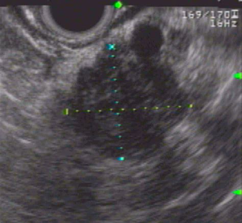 Eus Guided Tru Cut Biopsy For Serous Cystadenomas Of The Pancreas