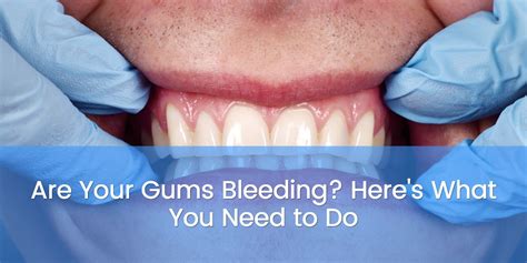 Are Your Gums Bleeding Heres What You Need To Do La Dental Clinic