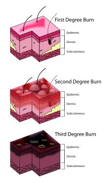 Third Degree Burns | SciJourner