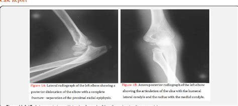 Proximal Radioulnar Joint