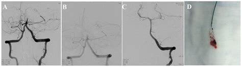 The Efficiency Analysis Of Thrombolytic Rt Pa Combined With Intravascular Interventional Therapy