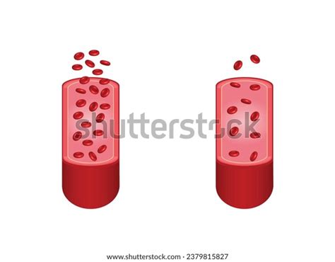 Iron Deficiency Anemia Difference Anemia Amount Stock Vector Royalty Free 2379815827