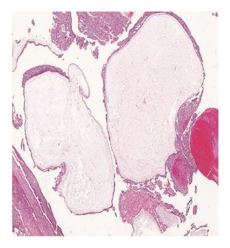 A Ct Scan Without Contrast Revealed Large Right Complex Adnexal Mass