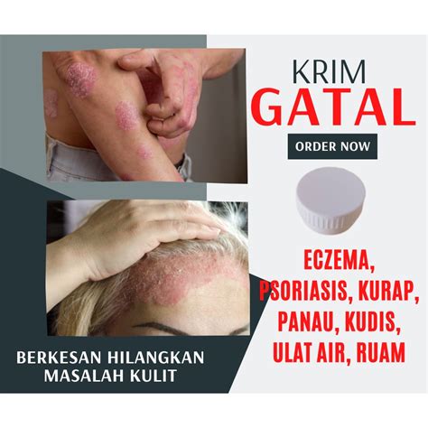 Psoriasis Cream Eczema Herbal Krim Herba Ubat Gatal Kurap Ezcema Ekzema