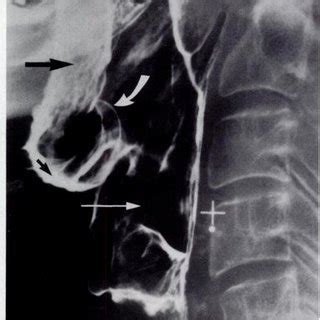 Figure h2 Figure h3 Lymphoid hyperplasia of the palatine tonsil A ...