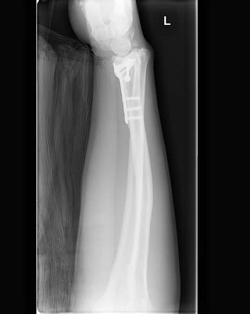 Essex Lopresti Fracture Dislocation Image Radiopaedia Org