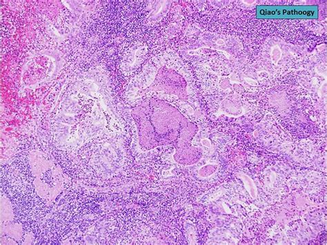 Qiao S Pathology Gallbladder Carcinoma Microscopic Photo Flickr