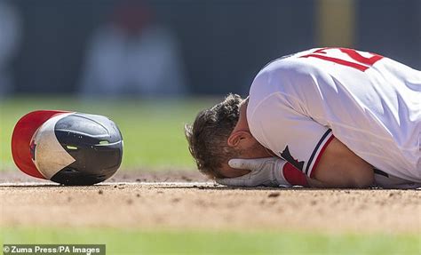 Minnesota Twins Pitcher Kyle Farmer Very Swollen Scarred After Hit