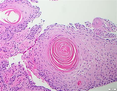 Pathology Outlines Squamous Cell Carcinoma