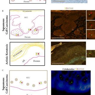 Donor Derived Cells In SCC And AK Express CD133 A Ki67 Staining Of