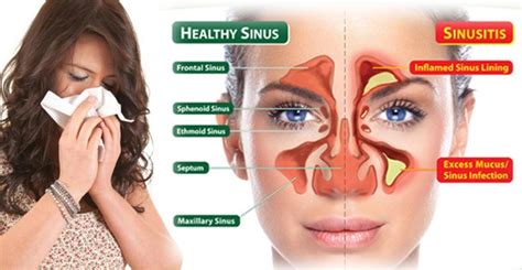 Sinusitis Rinosinusitis Panduan Praktik Klinis Bagi Dokter