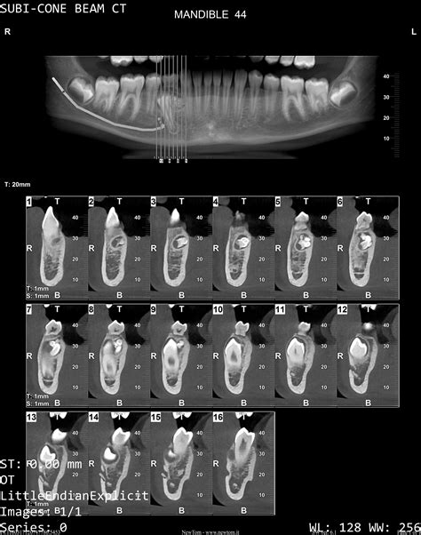 Happy Teratoma Tuesday! : r/Radiology