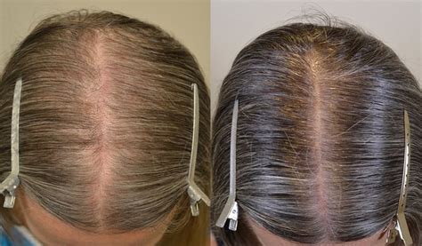 Finasteride And Topical Minoxidil Females Before And After Photos