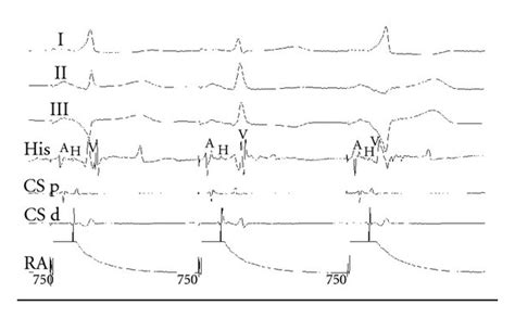 Surface Ecg And Intracardiac Electrograms During The Second