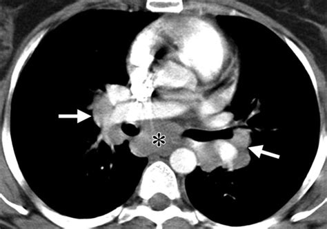 Pulmonary Sarcoidosis Typical And Atypical Manifestations At High Resolution Ct With Pathologic